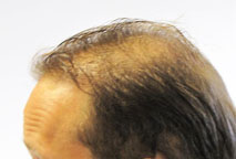 Exoderm Hair Implant