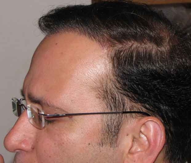 Exoderm Hair transplant